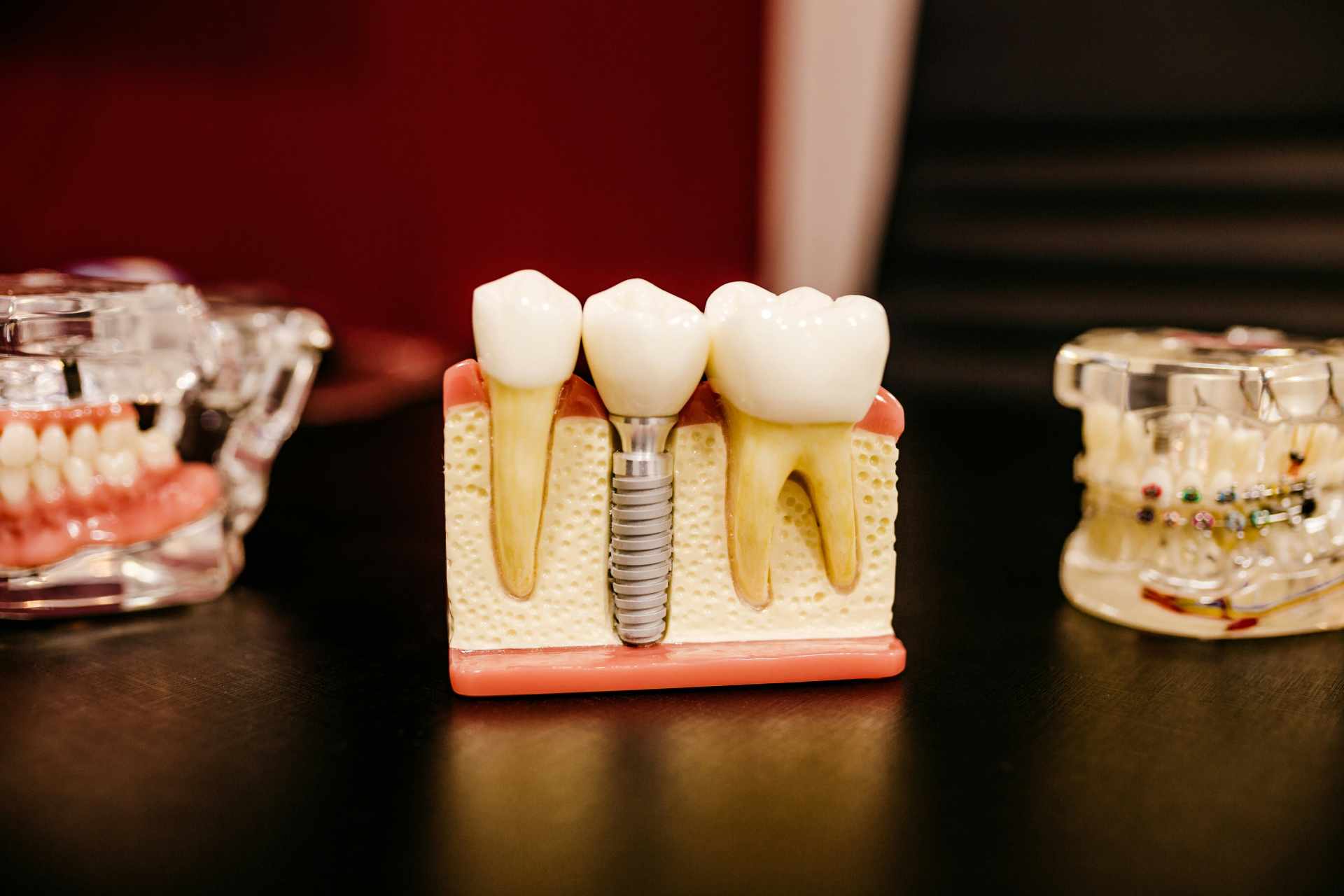 Dental İmplant Uygulamaları